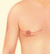 Incision patterns vary depending on the specific conditions and the surgeon's preference.