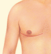 The areola can be reduced, or the nipple repositioned for a more natural chest contour.