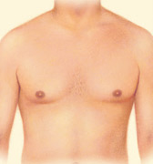 After liposuction, the patient has a flatter chest contour.