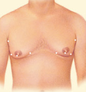 n cases where gynecomastia is primarily the result of excess fatty tissue, liposuction techniques alone may be used.