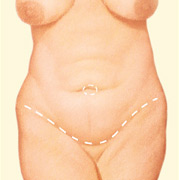 A full tummy tuck requires a horizontal incision in the area between the pubic hairline and navel.