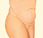In a full tummy tuck, a second incision around the navel may be necessary to remove excess skin in the upper abdomen.