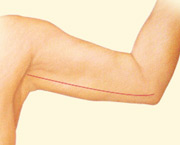 Arm lift surgery tightens loose, hanging tissue of the upper arm.