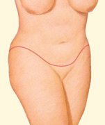 A circumferential incision around the body removes an apron of excess skin and fat and repositions and tightens tissues.