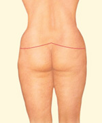 A complete lower body lift treats the buttocks, abdomen, waist, hips and thighs in one procedure.