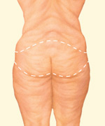 In a body lift, a circumferential incision removes an apron of loose skin and fat and tightens tissues of the buttocks, abdomen, waist, hips and thighs in one procedure.