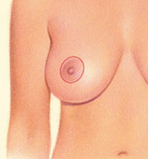 There are three common incision patterns for a breast lift. The first is around the areola.