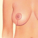 Around the areola and vertically down from the areola to the breast crease