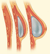 An expander is gradually filled with saline through an integrated or separate tube to stretch the skin enough to accept an implant beneath the chest muscle.