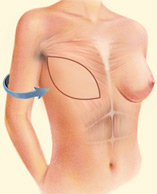 Tissue can be taken from the back and tunneled to the front of the chest wall to support the reconstructed breast.