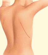 A Latissimus Dorsi flap uses muscle, fat and skin from the back tunneled to the mastectomy site and remains attached to its donor site, leaving blood supply intact.