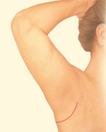 Minimal Arm Lift Incision - After