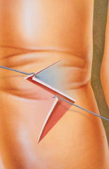 Using Z-plasty, the scar is removed and several incisions are made on each side, creating small triangular flaps of skin. Then the flaps are rearranged and interlocked to cover the affected area.