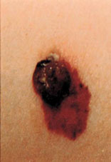 Malignant melanoma is often asymmetrical, with blurred or ragged edges and mottled colors.