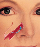 A bone/soft tissue flap is used to reconstruct the nose following skin cancer excision.
