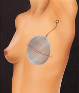 A silicone balloon expander is inserted beneath the skin. Once in place, the expander is gradually filled with salt water through a tiny valve.